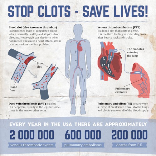 Blood clot infographic