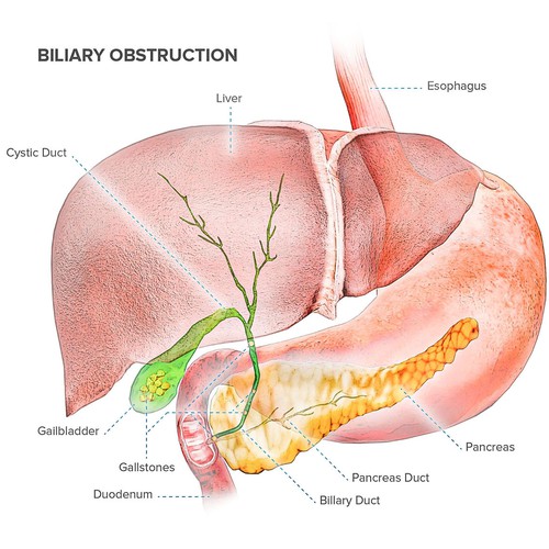 Billiary Obstruction Illustration