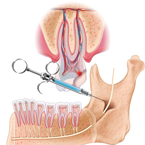 Detailed medical illustration with dental syringe.