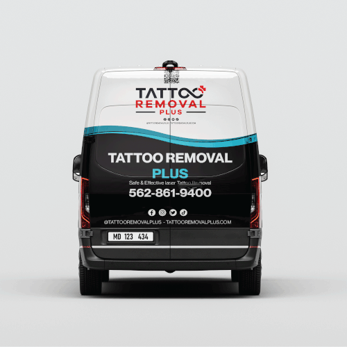 Tattoo Removal