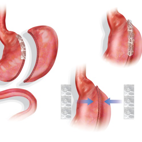 Gastric Surgery Illustrations
