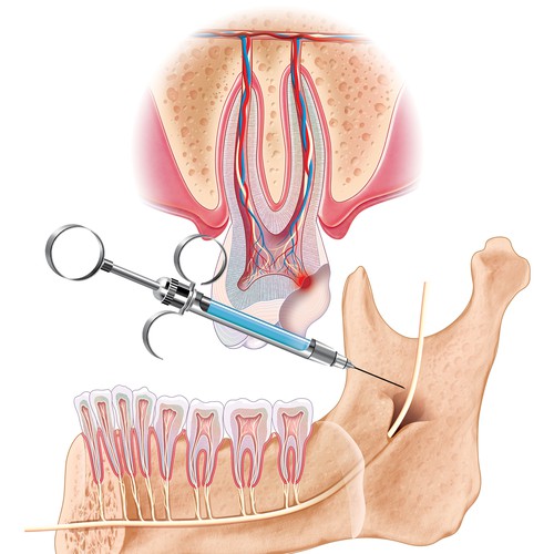 Detailed medical illustration with dental syringe.