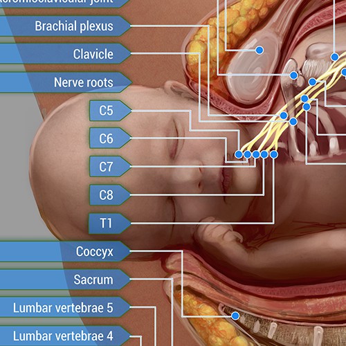 Poster - dystocia 