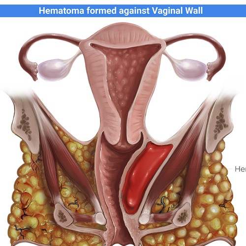 Hematoma illustration