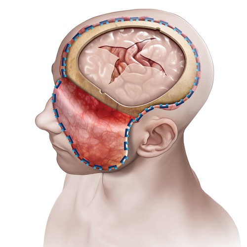 Craniectomy Illustration 