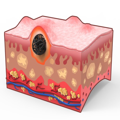 Medical Skin Bump illustration