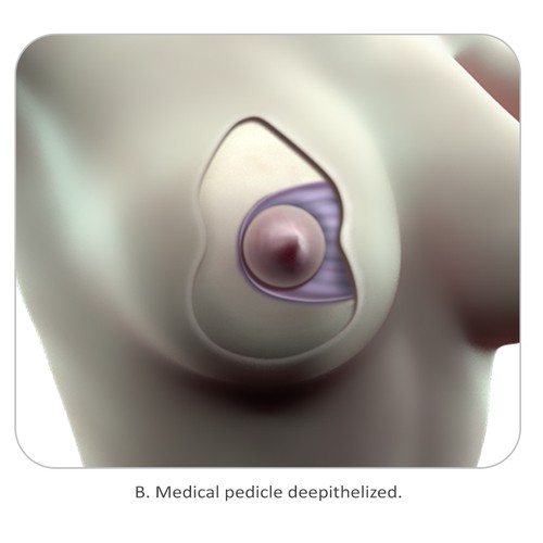 Medical Illustrations of Plastic Surgery