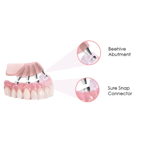 Create an illustration for dental implant bridge