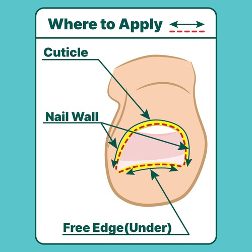 Лечение грибка ногтей - схема применения
