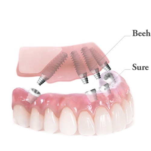 Create an illustration for dental implant bridge