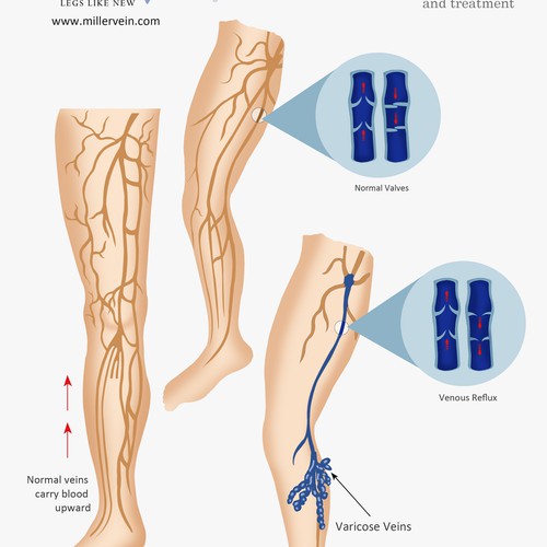 Understanding Venous insufficiency