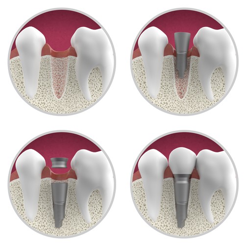 Dental implant