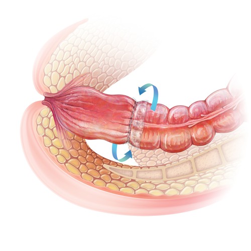 Colon Anastomosis Application Techniques