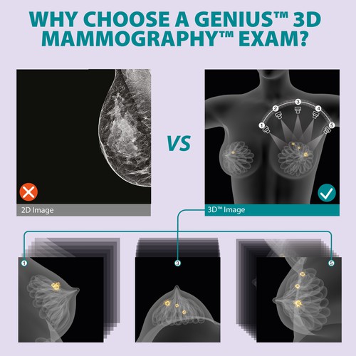 3D Mammography